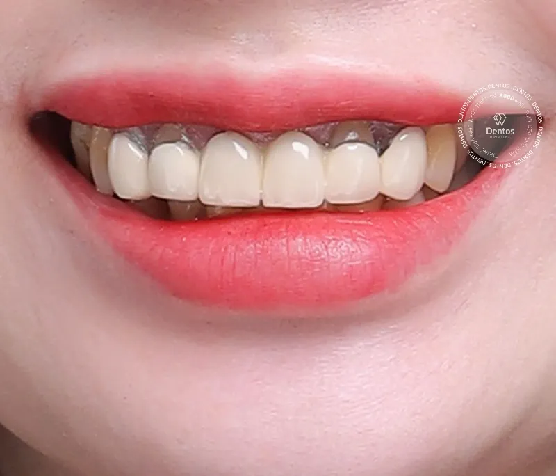 Bọc răng sứ giá rẻ: Bóc trần sự thật và hậu quả khôn lường